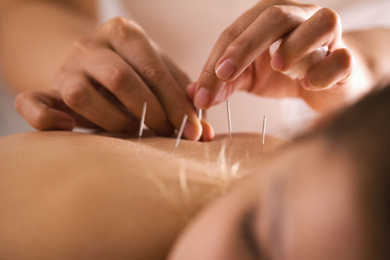 The,Doctor,Sticks,Needles,Into,The,Girl's,Body,On,The Acupuncture Therapy Services