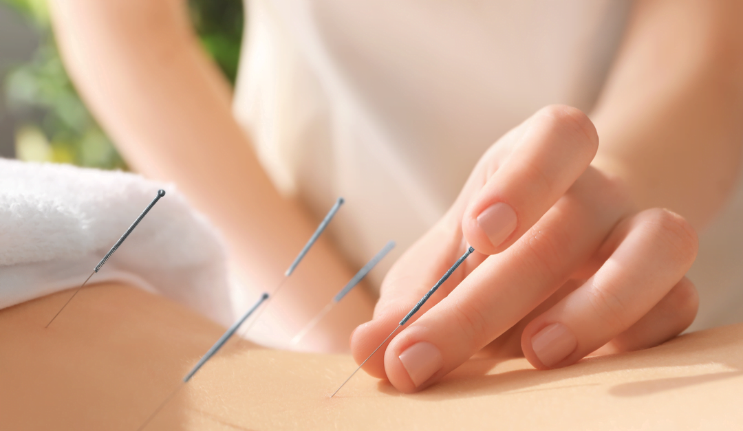 Things You Should Know Before Starting Acupuncture