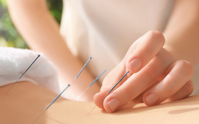 Things You Should Know Before Starting Acupuncture