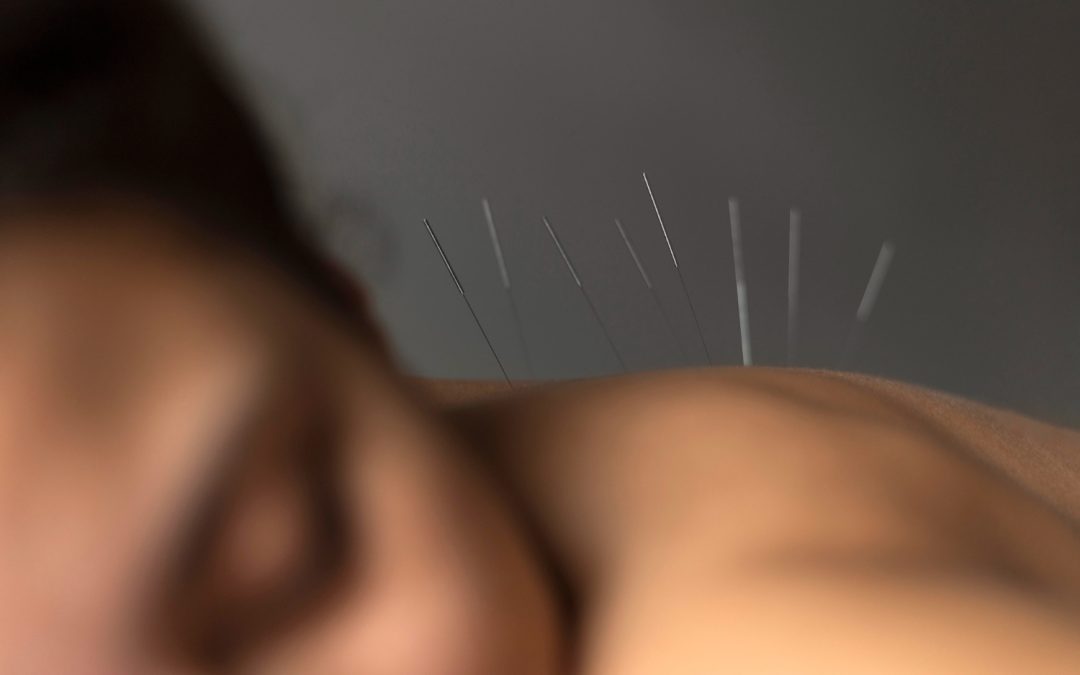 The Benefits of Acupuncture: A Modern Approach to Ancient Healing