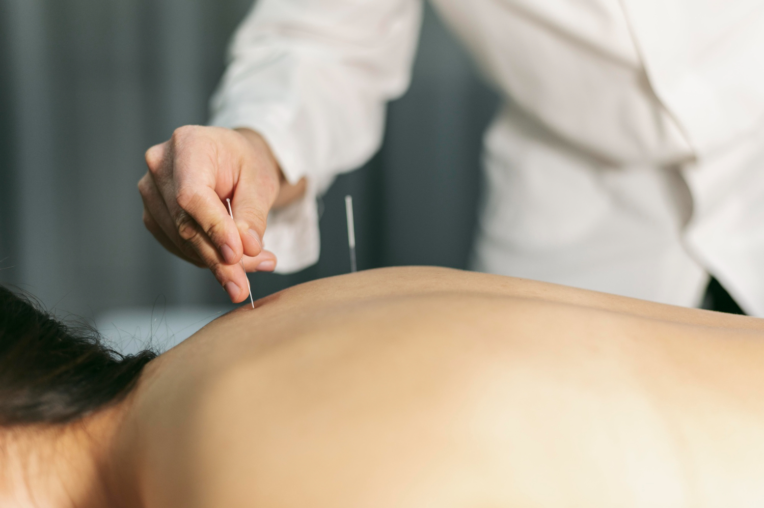 Close-up of an acupuncturist inserting needles into a person's bare back during an acupuncture treatment. Benefits of Acupuncture