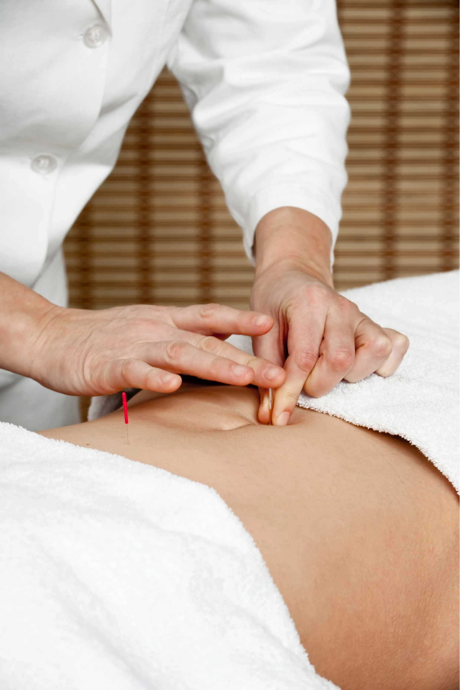 fertility-acupuncture-1 Person receiving acupuncture on their back, covered with a white towel in a calm setting with a bamboo backdrop.