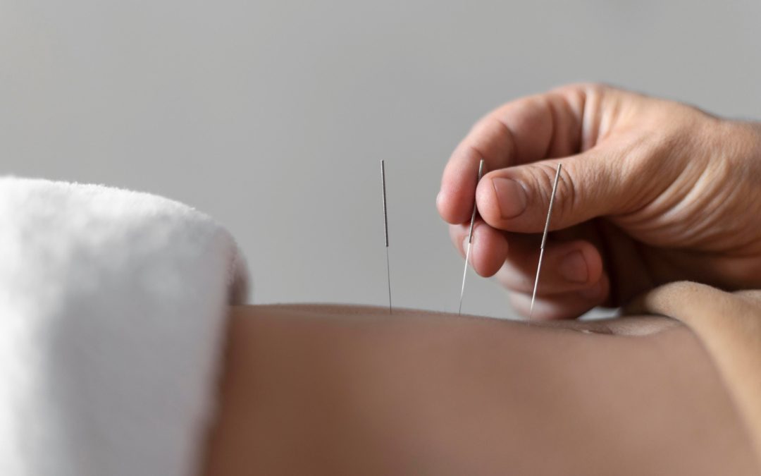 Acupuncture for Digestive Health: How Traditional Techniques Support Modern Wellness