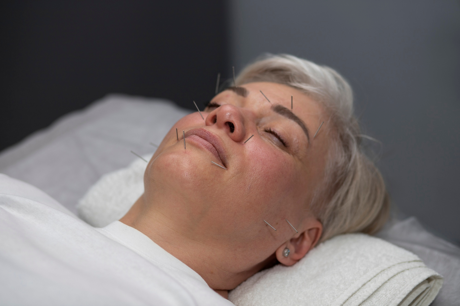 2149406797 A woman with acupuncture needles in her face lies on a treatment table with her eyes closed.